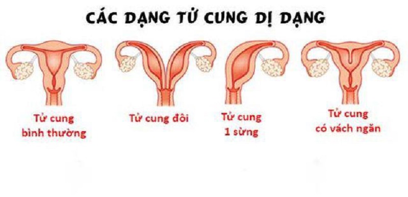 một vài dạng dị dạng tử cung bẩm sinh